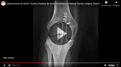 Osteosintesis de Rótula Dr. Esteban Castro Contreras - Traumatólogo y Ortopedista