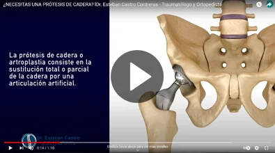Prótesis de Cadera Dr. Esteban Castro Contreras - Traumatólogo y Ortopedista